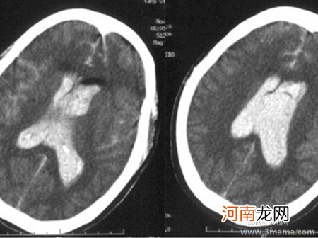 孕晚期侧脑室突然增宽