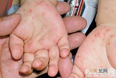 【手足口病】手足口病症状表现、手足口病图片