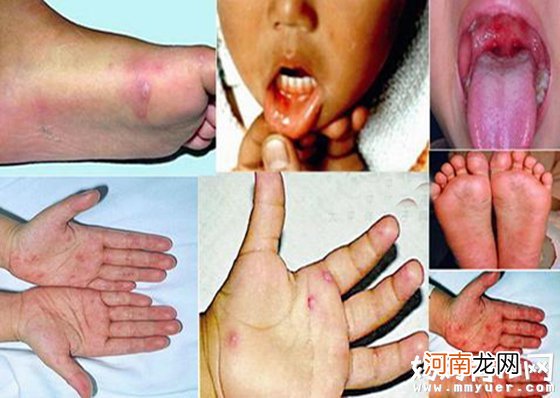 【手足口病】手足口病症状表现、手足口病图片