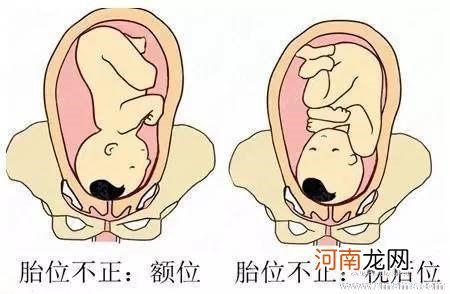 胎位不正选择什么分娩方式好