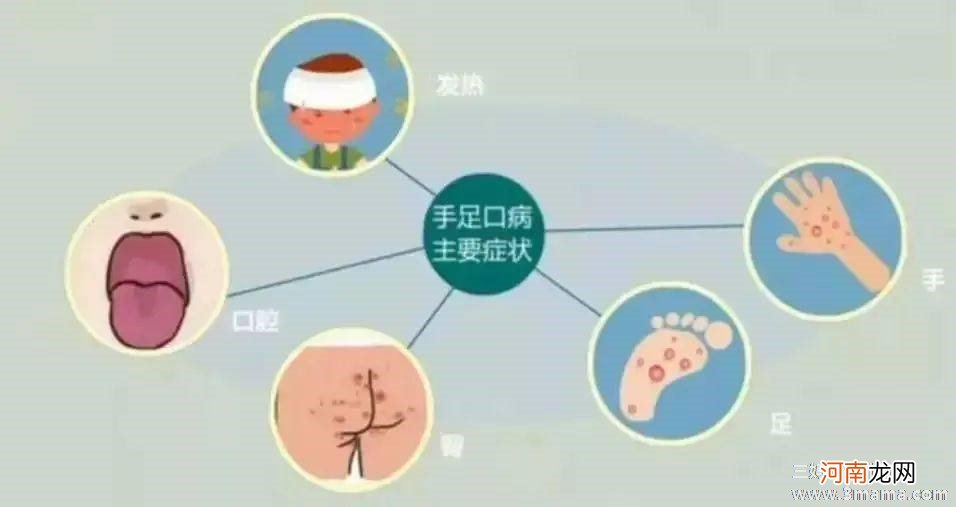 手足口病的口腔护理要点