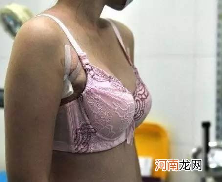 乳房流白色分泌是什么