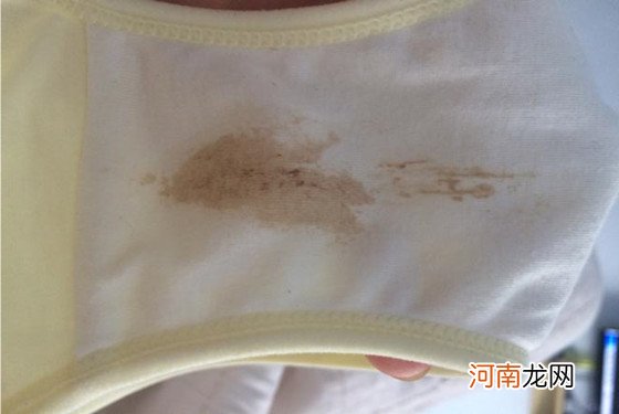 乳腺挤出褐色分泌物