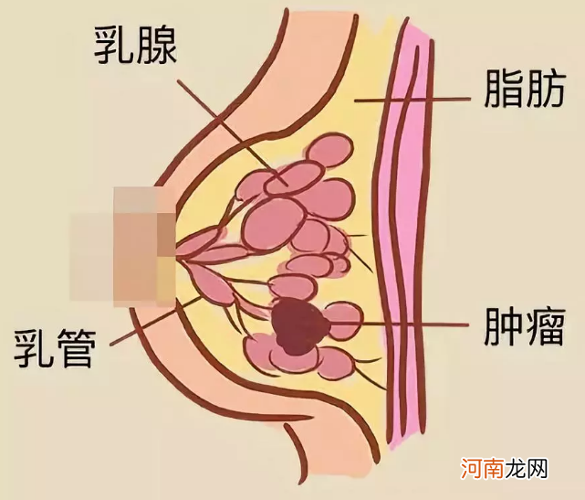 乳腺纤维瘤有溢液现象