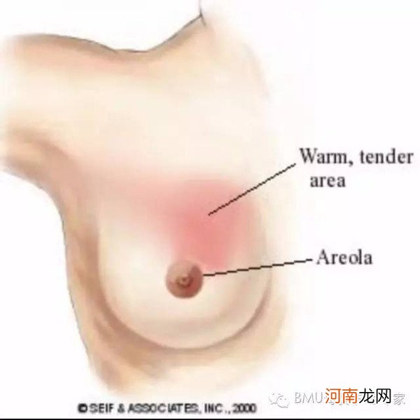 乳腺炎早期如何治疗