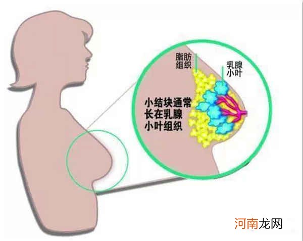 乳腺结节良性恶性