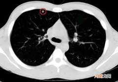 乳腺结节4a类一般良性