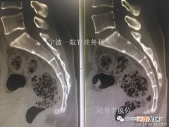 孕晚期尾骨疼怎么缓解