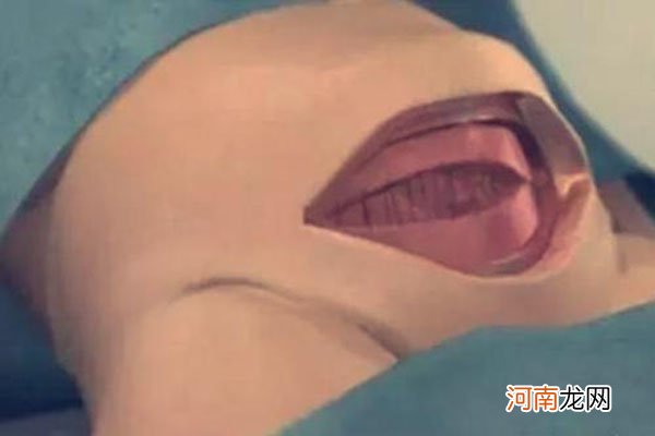 八张图详解剖腹产手术全过程 看完真的好心疼女人