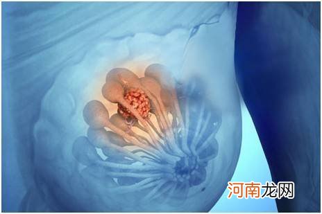 乳腺钼靶0类是好是坏