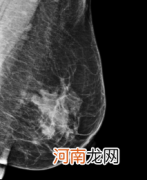 乳腺钼靶0类是好是坏