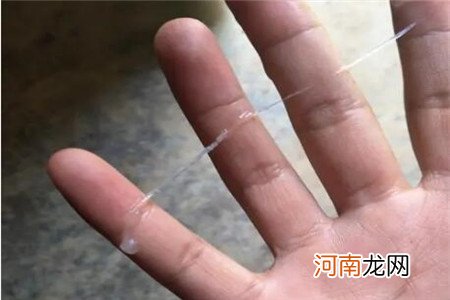 子宫肌瘤的症状以及预防方法