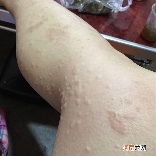 过敏性皮炎咋办 过敏性皮炎怎么治疗彻底