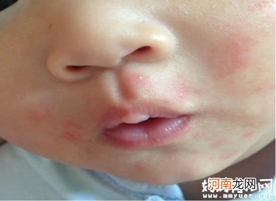 宝宝脸上长小红疙瘩怎么办 如何治疗快速又有效