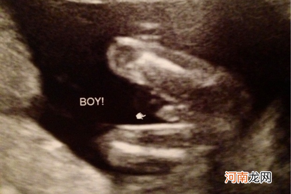 已确定怀儿子孕晚期照片 B超已确定小JJ图片