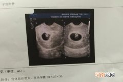 孕囊看男宝女宝已证实 已生宝妈都说看孕囊很准