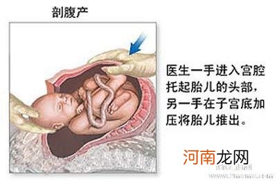 真实！剖腹产全过程图解 - 剖腹产