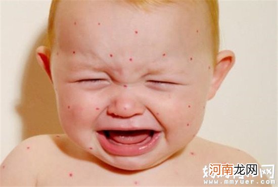 幼儿急疹出疹几天消退 幼儿急疹出疹后的护理