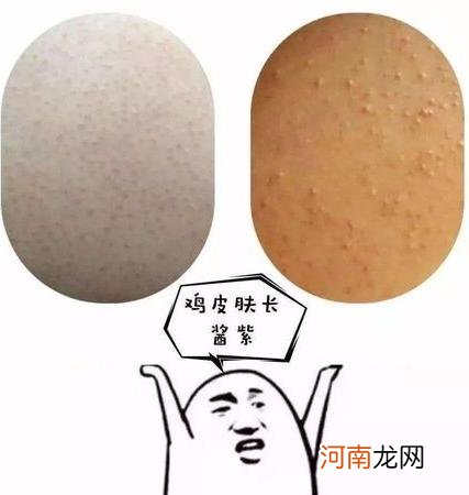 脖子鸡皮肤怎么消除？什么是脖子鸡皮肤？