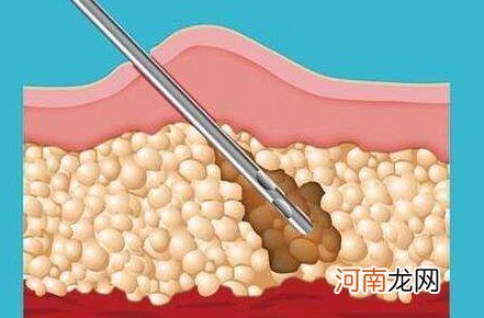 全身抽脂20斤多少钱