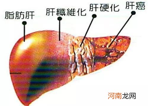 中度脂肪肝多久癌变