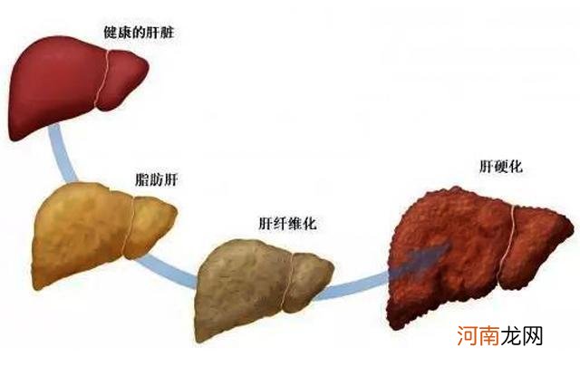 重度脂肪肝中医治疗方法