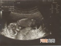 胎儿性别早知道 怀孕5周就能知道胎儿性别？