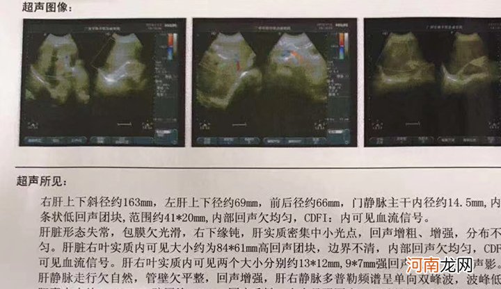 脂肪肝每天快走多长时间最好