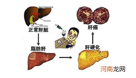 重度脂肪肝改变