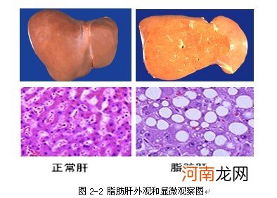 脂肪肝有什么特效药