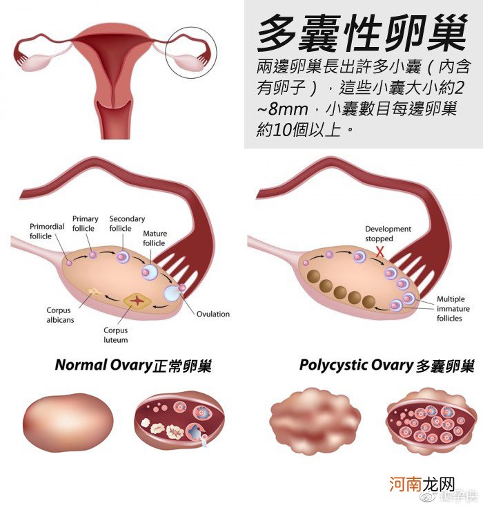 什么是多囊卵巢? 什么人容易得多囊卵巢