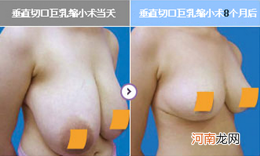 乳房萎缩还能恢复吗