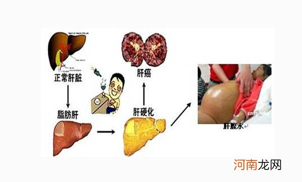 请问肝饮食要注意些什么