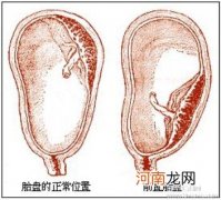 孕晚期胎盘位于前壁