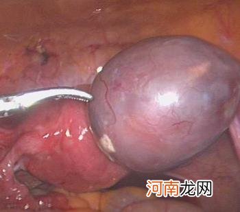 子宫肌瘤为何导致不孕