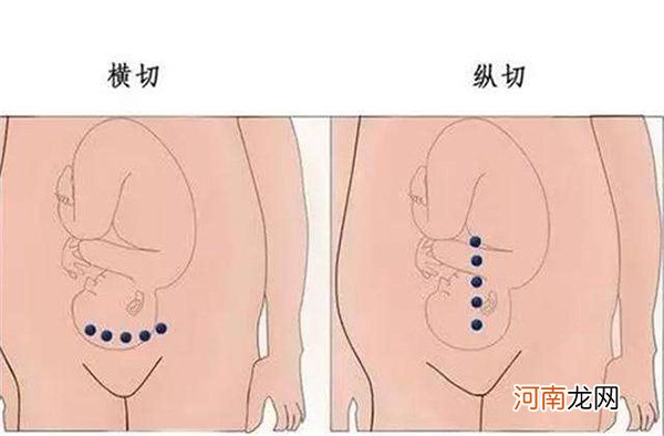 剖腹产竖切好还是横切好 妇产科医生是这样建议的