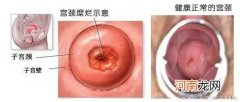 宫颈hpv52阳性能顺产吗