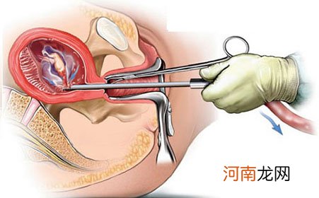 怀孕8周打掉危险吗