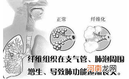 脂肪肝肝纤维化能治愈吗