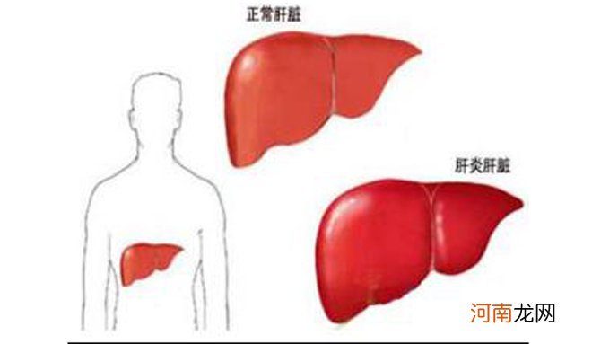 得了慢性肝病能治好吗