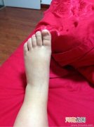 孕晚期脚肿为什么会痒