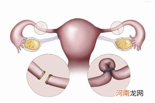 女性结扎的好处和坏处 别被骗了根本没有好处