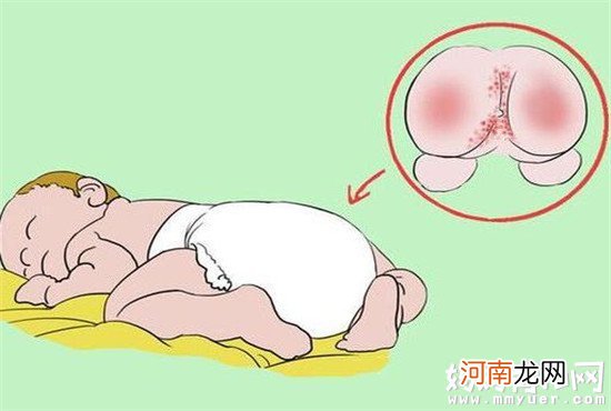 宝宝肛门红怎么回事 宝宝肛门红的五大原因及应对方法