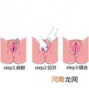 会阴侧切会影响以后的夫妻活吗