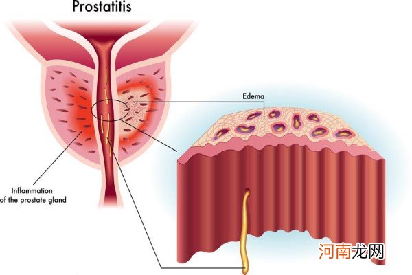 前列腺钙化可以生育吗 男性健康问题是时候引起重视了