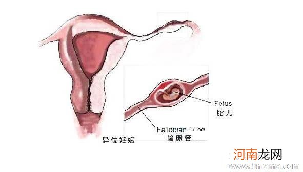 宫外孕早期症状到底有哪些