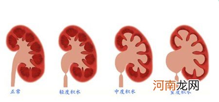 胎儿肾积水应该注意那些 胎儿肾积水要注意的问题