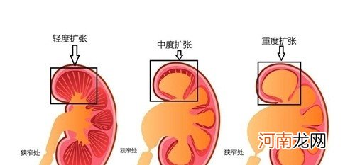 胎儿肾积水应该注意那些 胎儿肾积水要注意的问题