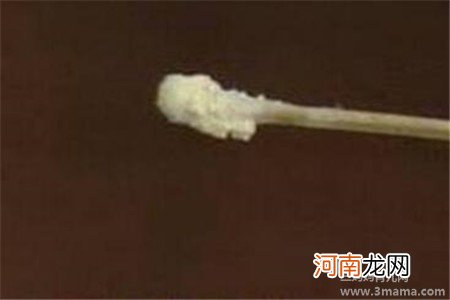 孕晚期白带呈豆腐渣状