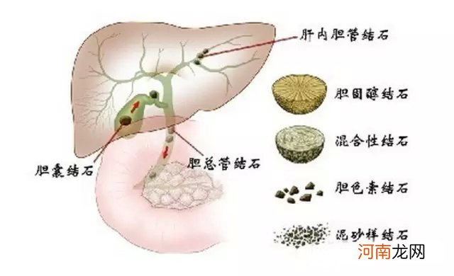 肝内胆管结石怎么引起的